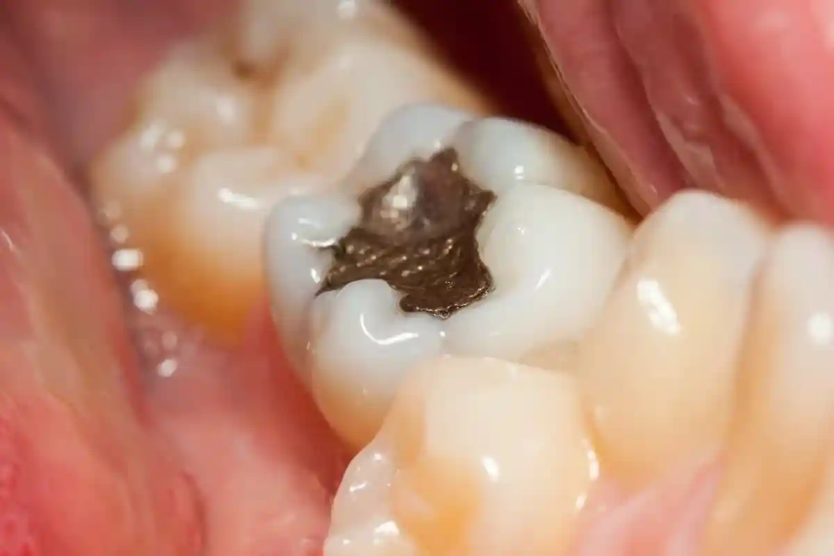 Металлические пломбы имеют блестящий цвет, резко контрастирующий с эмалью зуба. Поэтому ставить их приемлемо только на задние зубы. Фото: shutterstock.com