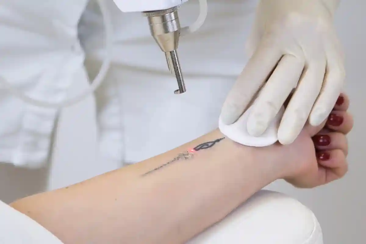 Удаление татуировки лазером смогут делать только врачи. Фото: UvGroup / shutterstock.com