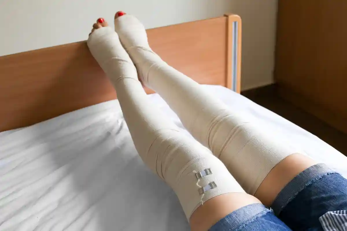 Профилактическая послеоперационная эластичная повязка на ноги для профилактики варикоза Фото: NYU Studio / Shutterstock.com