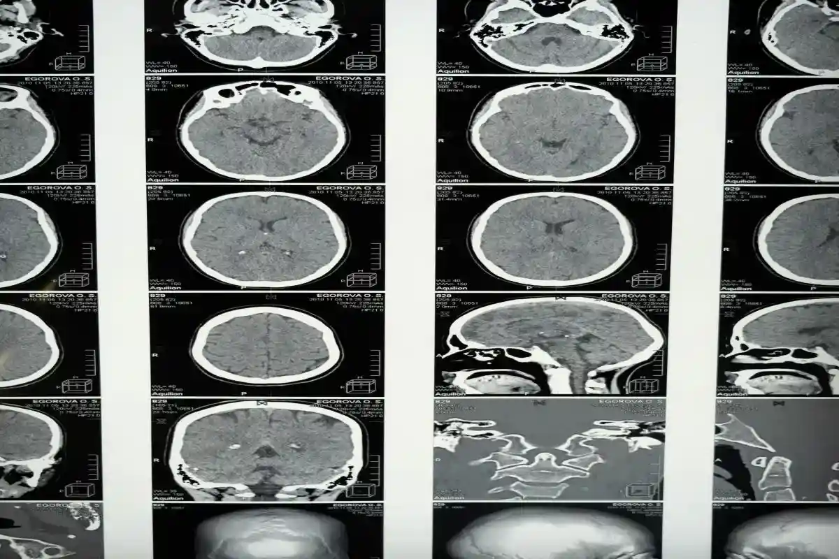 Потеря обоняния из-за COVID-19 вызвана повреждением головного мозга