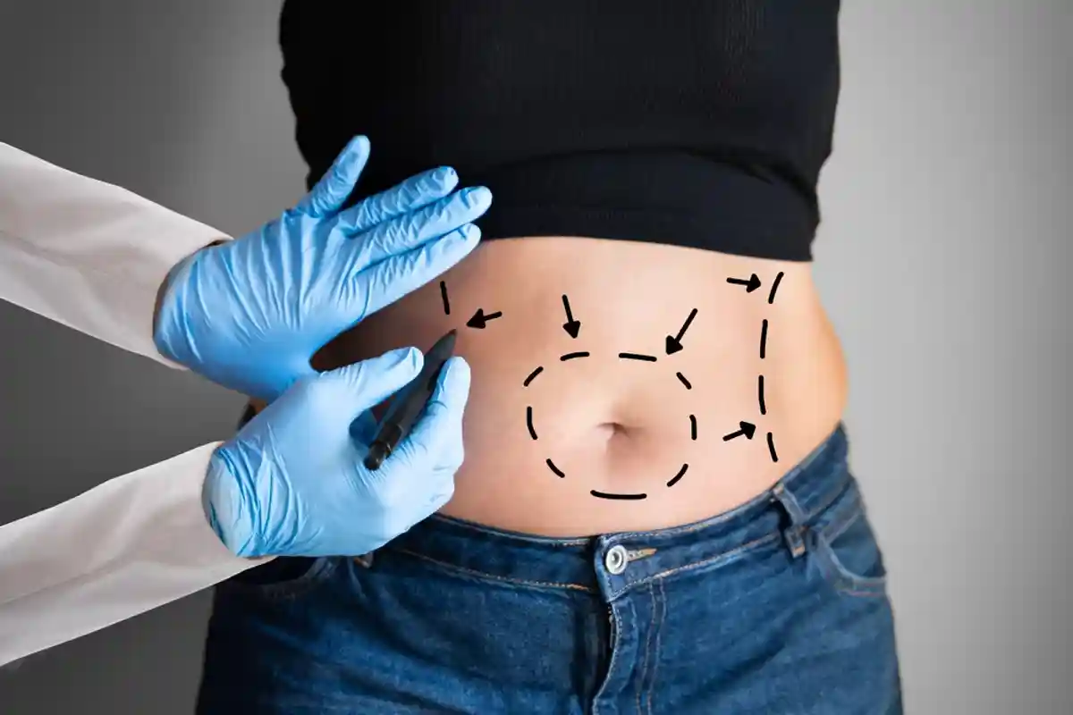 Липосакция — косметическая операция по удалению жировых отложений хирургическим путём. Фото: Shutterstock