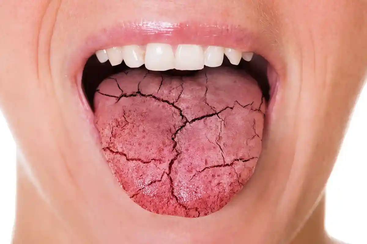 Длительная сухость во рту, помимо прочего, может повысить риск развития кариеса. Фото: Andrey_Popov / shutterstock.com