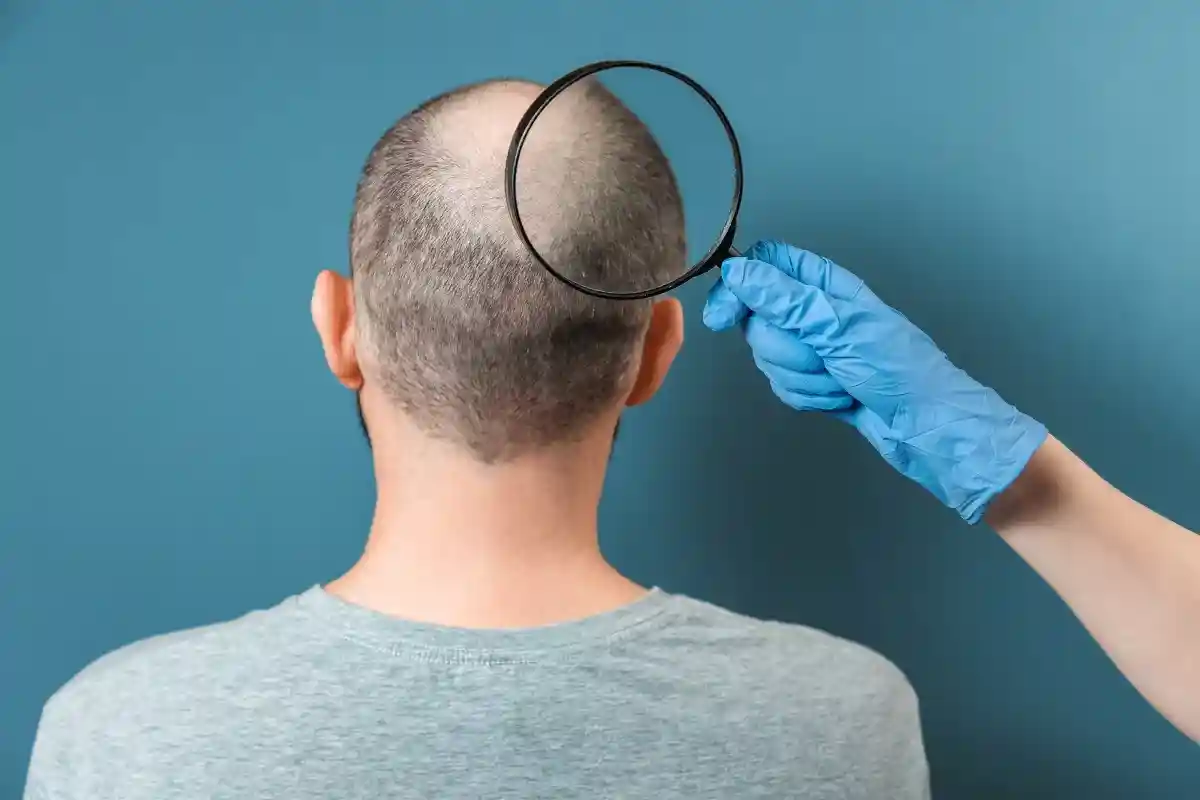 Медики нашли способ лечить выпадение волос после COVID-19