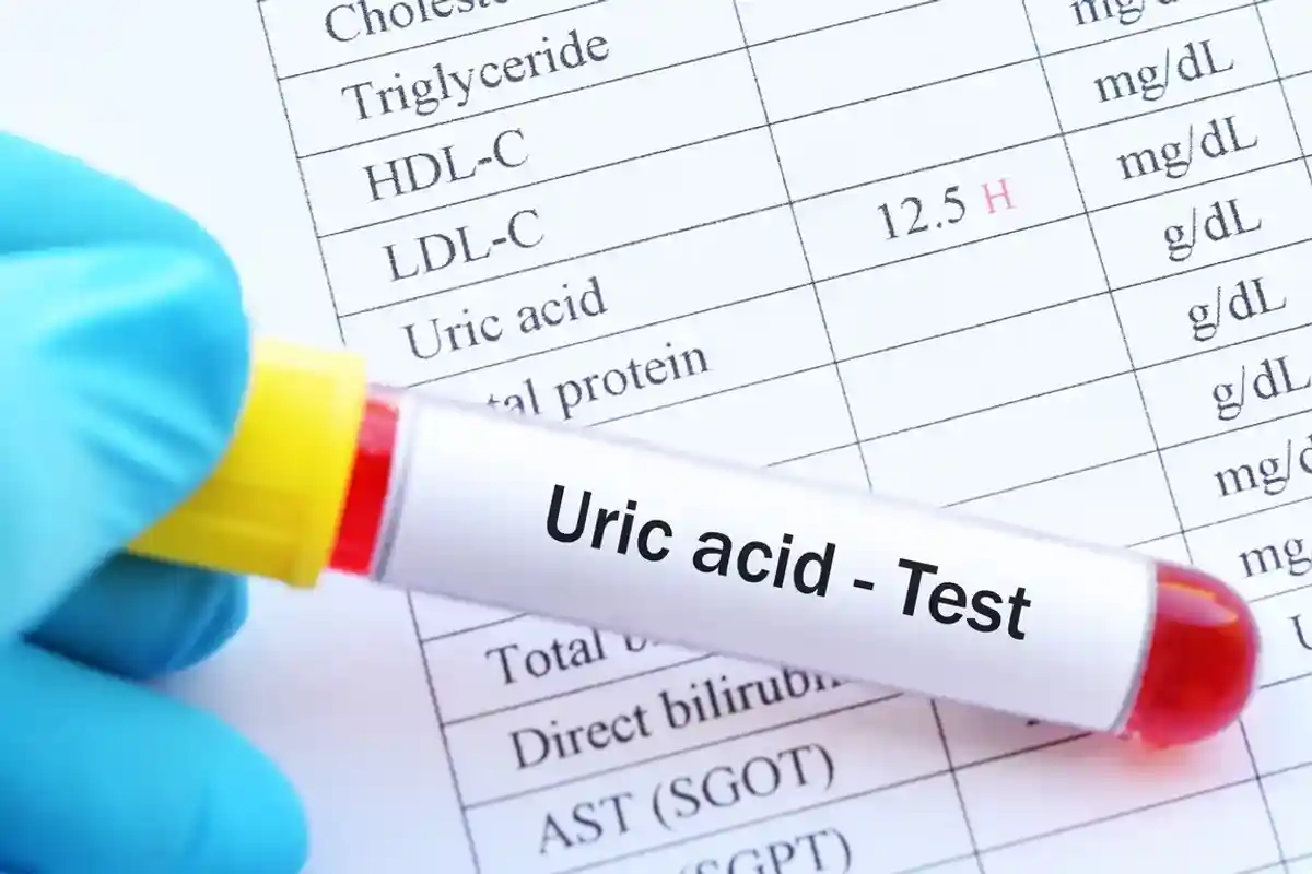 Acido urico cetosis