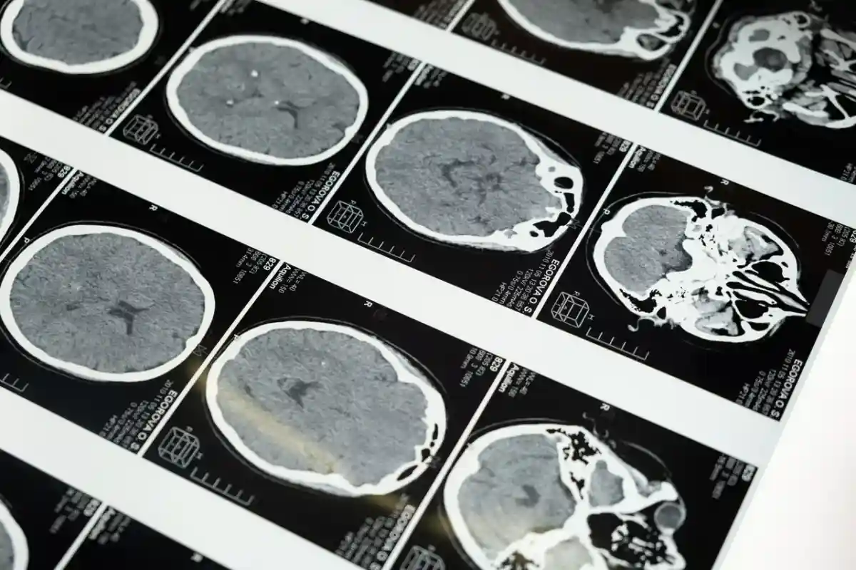 Употребление алкоголя может повредить мозг: исследователи обнаружили отложения железа, что характерно для болезни Паркинсона. Фото: cottonbro / pexels.com