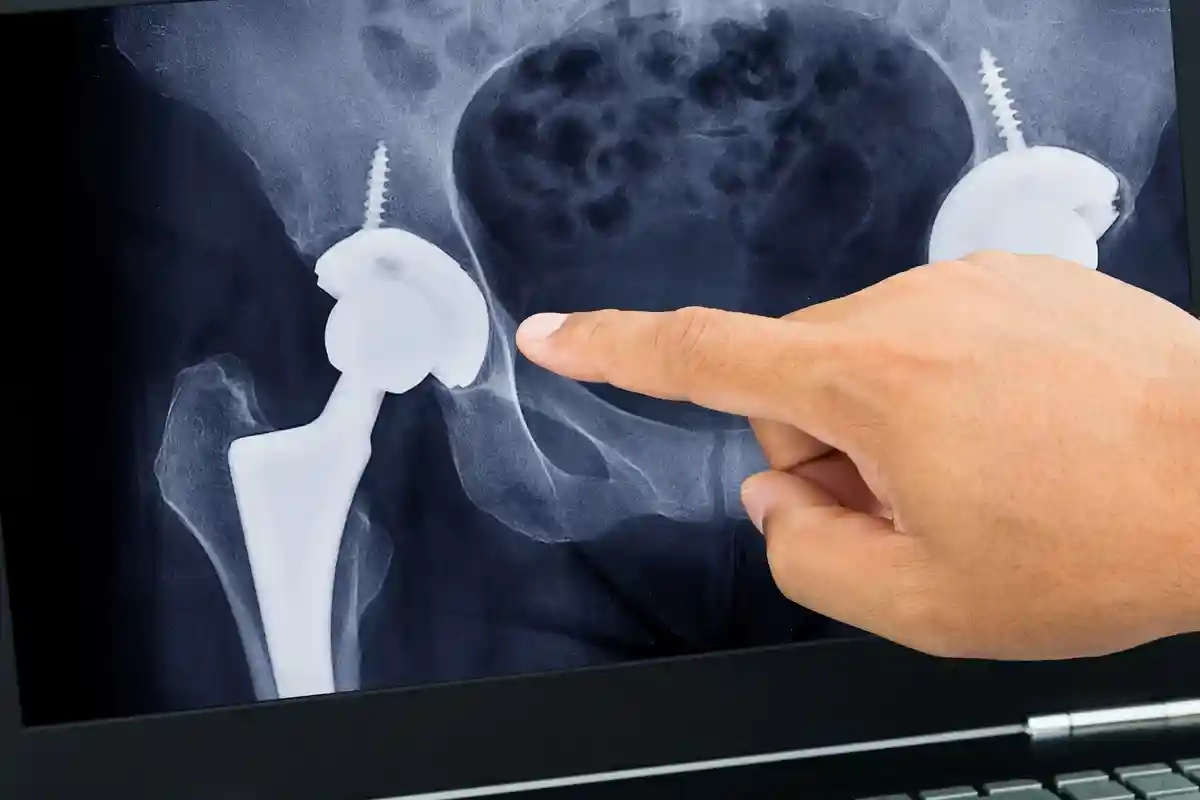 Рука врача указывает на рентгеновские снимки тотального эндопротезирования тазобедренного сустава Фото: ChooChin / Shutterstock.com