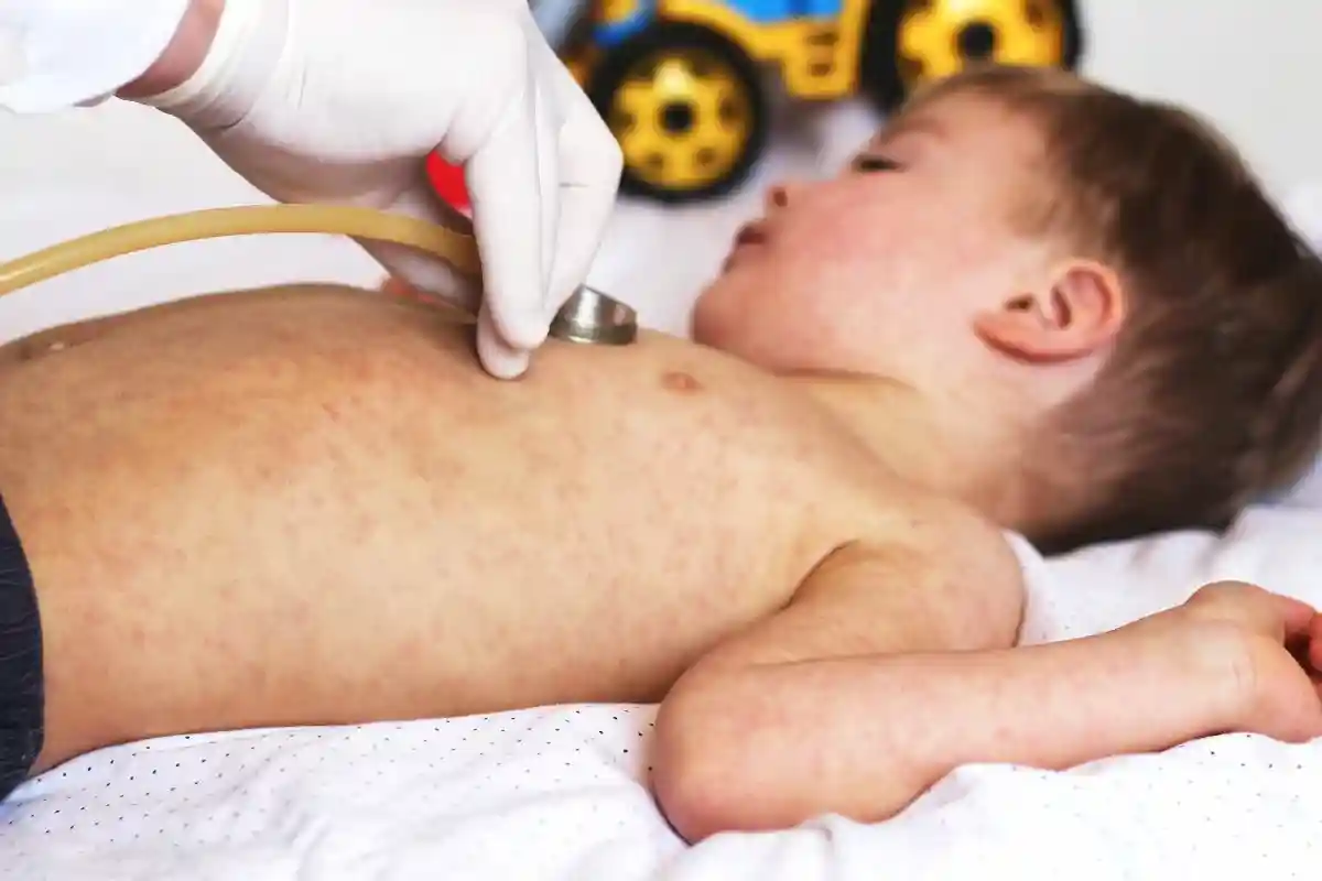 Суд подтвердил вакцинацию от кори: эксперты предостерегают от преуменьшения значения болезни. Фото: fotohay / shutterstock.com