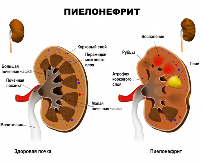 Сравнение здоровой почки (слева) и почки, пораженной пиелонефритом (справа) Фото: www.gdp1podolsk.ru