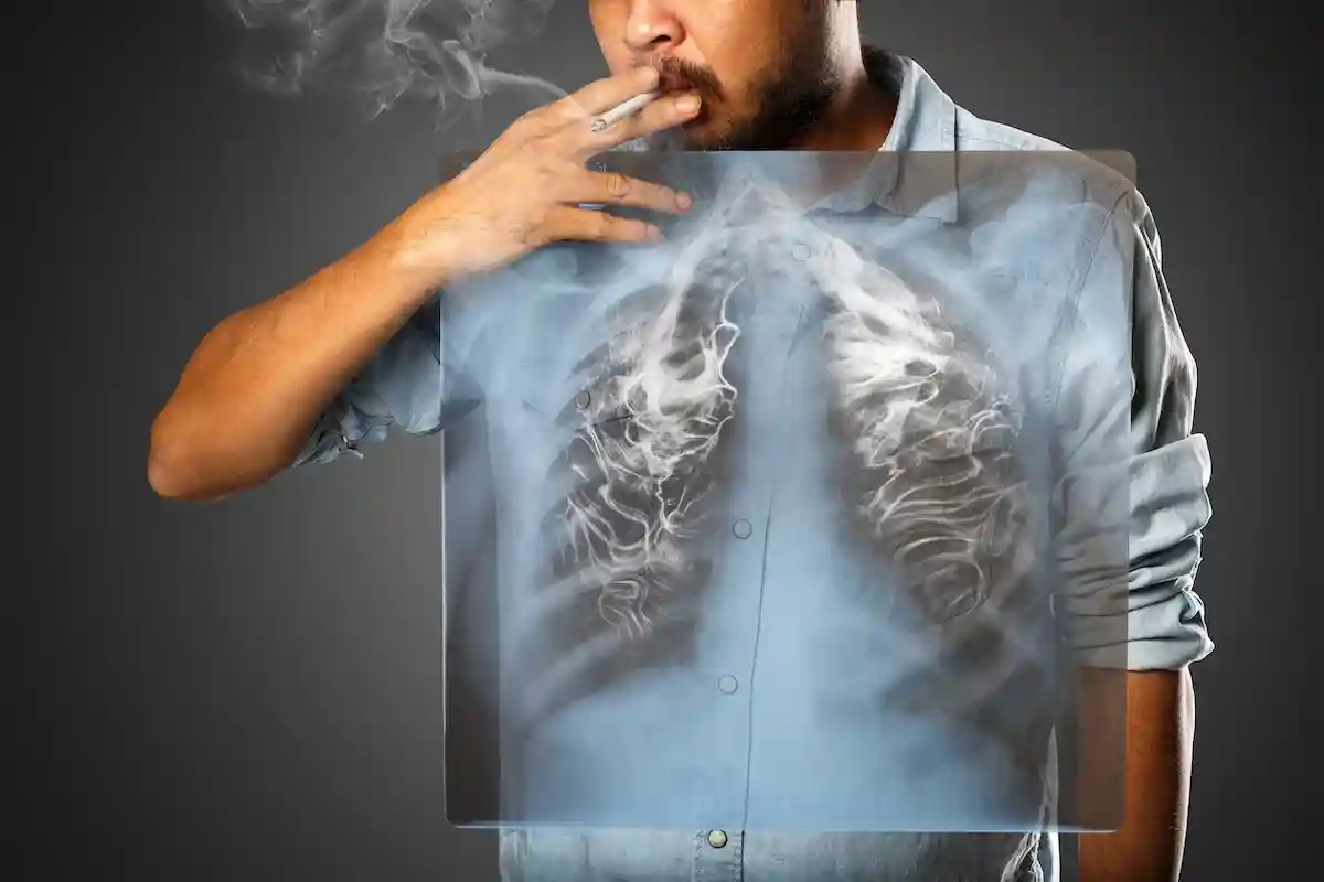 Курение и малоподвижность могут быть причинами инсульта. Фото: Krunja / Shutterstock.com