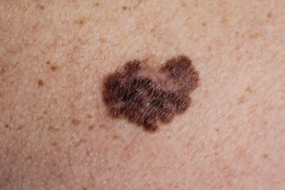 Как распознать рак черной кожи: если родинка выглядит необычно, это может быть признаком того, что пигментное пятно является раком черной кожи. Фото: Nasekomoe / shutterstock.com