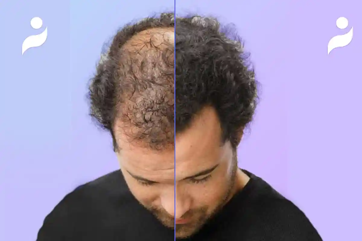 Знакомство с iHairium: ваш главный помощник для восстановления волос